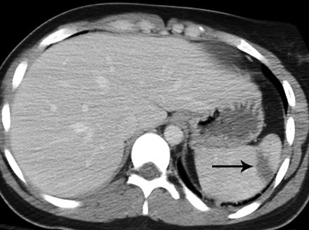 Grade II Splenic Injury