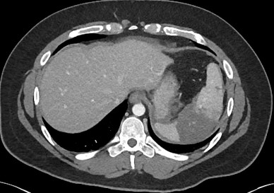 Grade III Splenic Injury