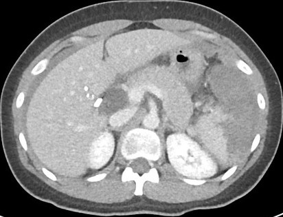 Grade IV Splenic Injury