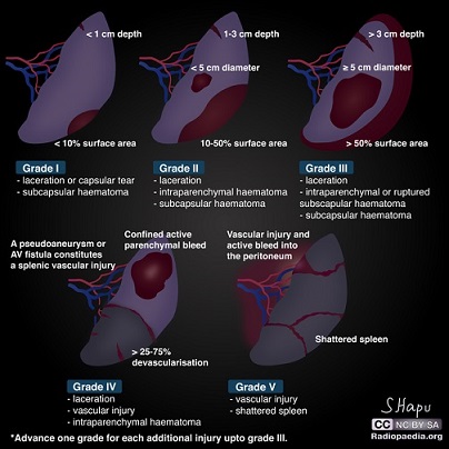 Splenic Trauma Grading