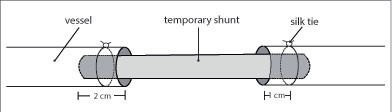 Temporary Intracascular shunt