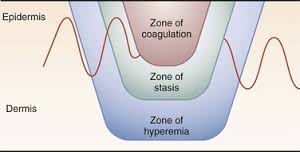 Burn Wound Zones of Injury