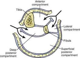 Four Compartment Fasciotomy