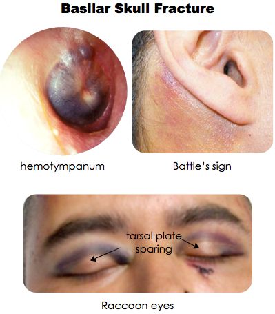 Basilar Skull Fracture