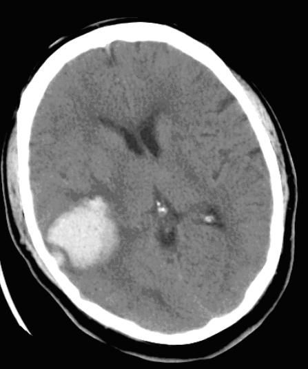 Cerebral Contusion