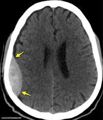 Epidural Hematoma