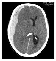 Subdural Hematoma