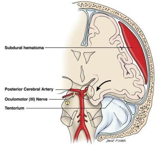 Uncal Herniation