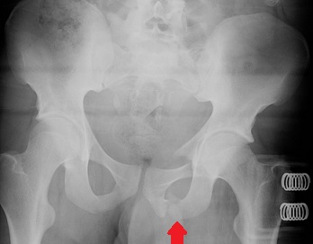 Superior and Inferior Pubic Rami Fractures