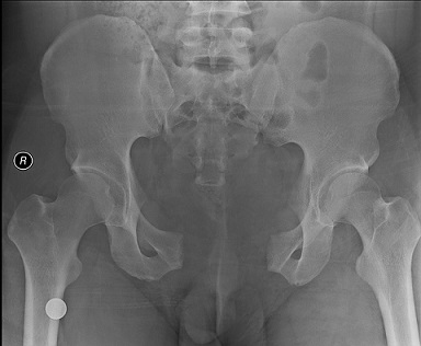 Open Book Pelvic Fracture