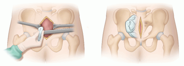 Preperitoneal Pelvic Packing