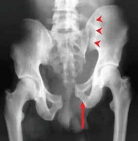 Vertical Shear Pelvic Fracture