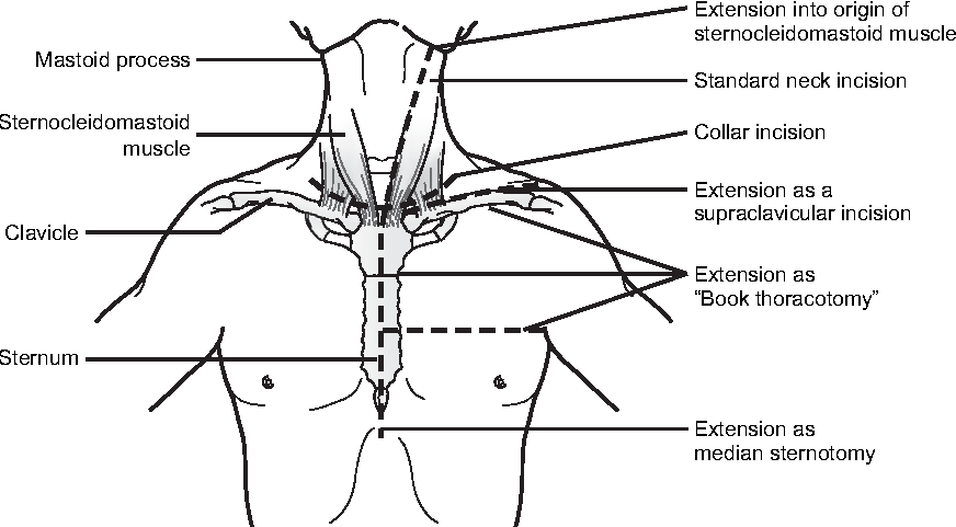 Possible incisions for penetrating Neck Trauma