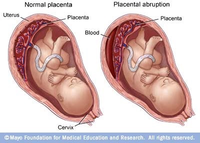 Placental Abruption