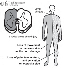 Brown-Sequard Syndrome