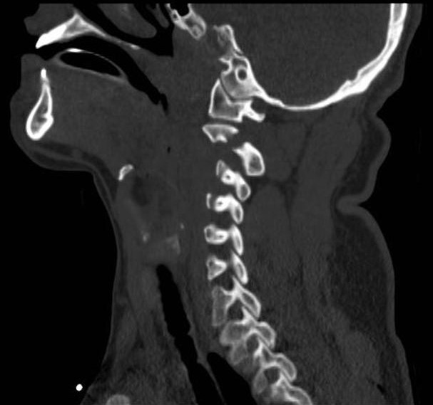 Hangman's Fracture