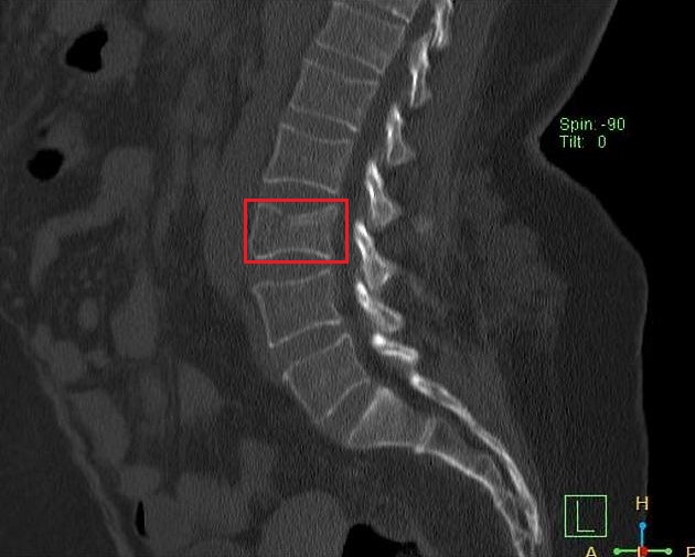 L3 Wedge Compression Fracture