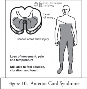 Anterior Cord Syndrome