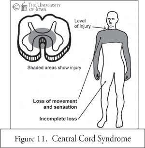 Central Cord Syndrome