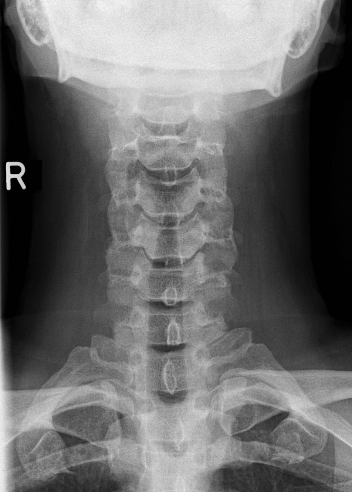 Normal A-P C-Spine X-ray