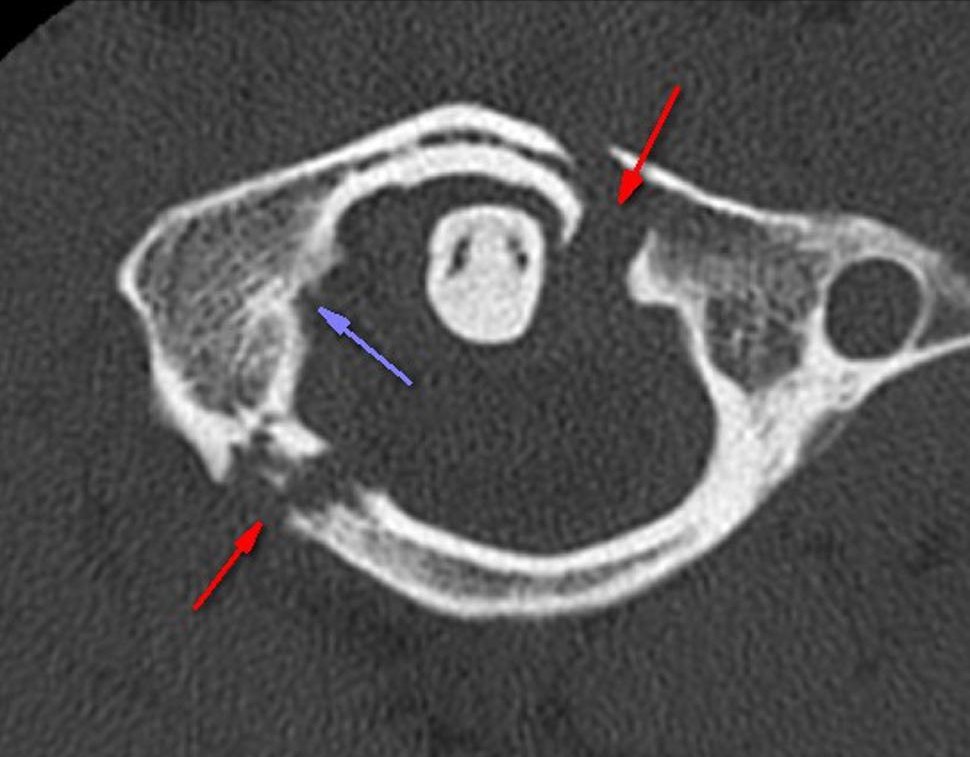 Jefferson Burst Fracture