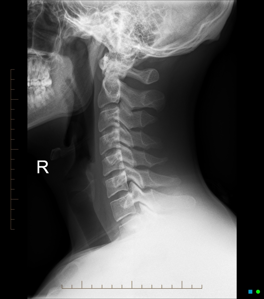 Normal Lateral C-Spine X-ray