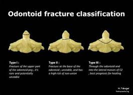 Odontoid Fracture classififcation