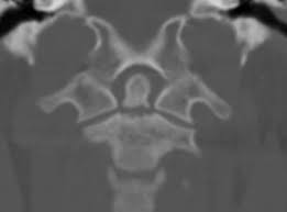 Type 2 Odontoid Fracture