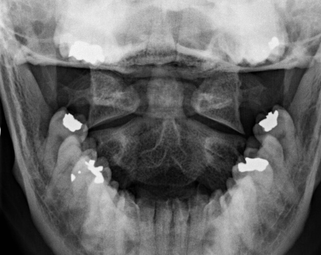 Normal Odontoid View X-ray