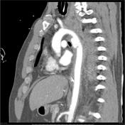 Traumatic Aortic Pseudoaneurysm