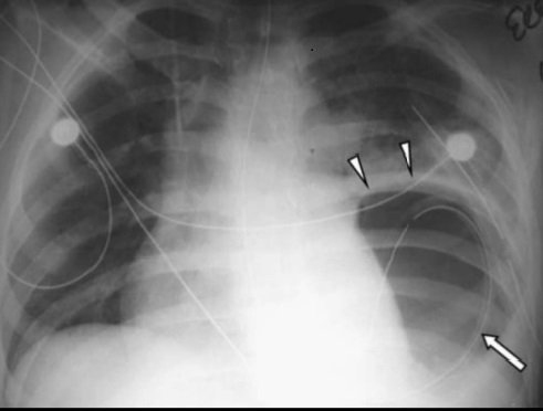 Diaphragmatic Rupture