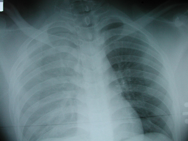 Hemothorax