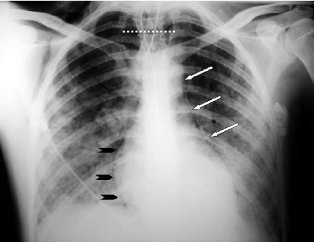 Pneumomediastinum