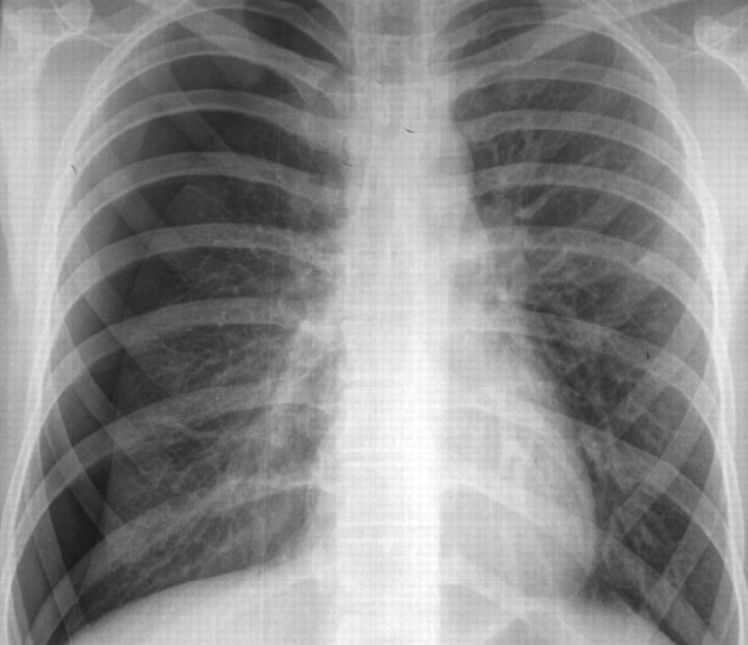 Pneumothorax