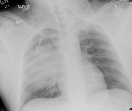 Pulmonary Contusion