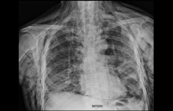 Extensive Subcutaneous Emphysema