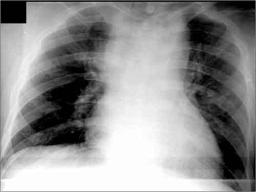 CXR - Widened Mediastinum