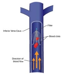 Vena Cava Filter