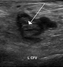 Common Femoral Vein Thrombosis