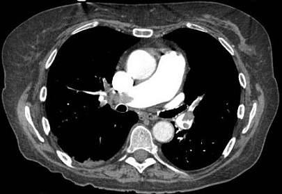 CTA - Pulmonary Embolus