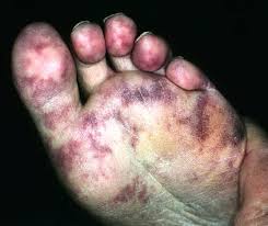 Blue Toe Syndrome