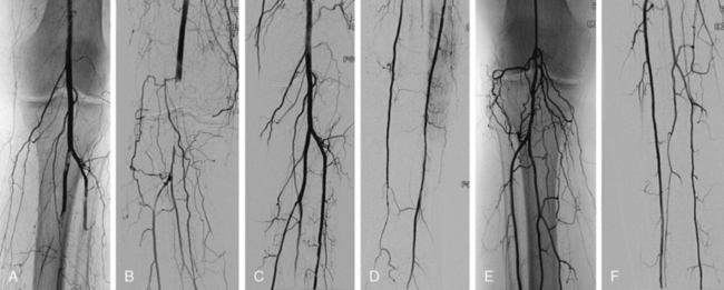 Bilateral Lower Limb Emboli