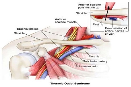 Thoracic Outlet Syndrome