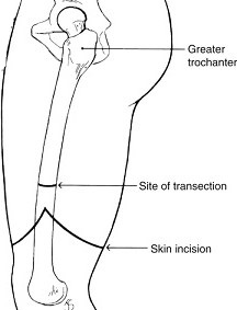 Above Knee Amputation Incision