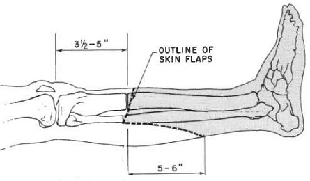 Below Knee Amputation Incision