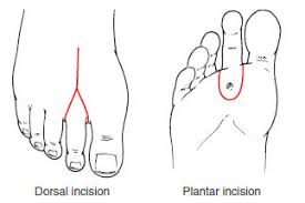 Ray Amputation Incisions