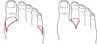 Toe Amputation Incisions