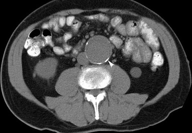 AAA - CT Scan