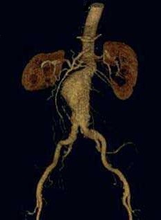 AAA - CT Angiogram