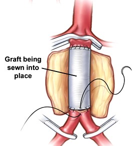 AAA - Tube Graft